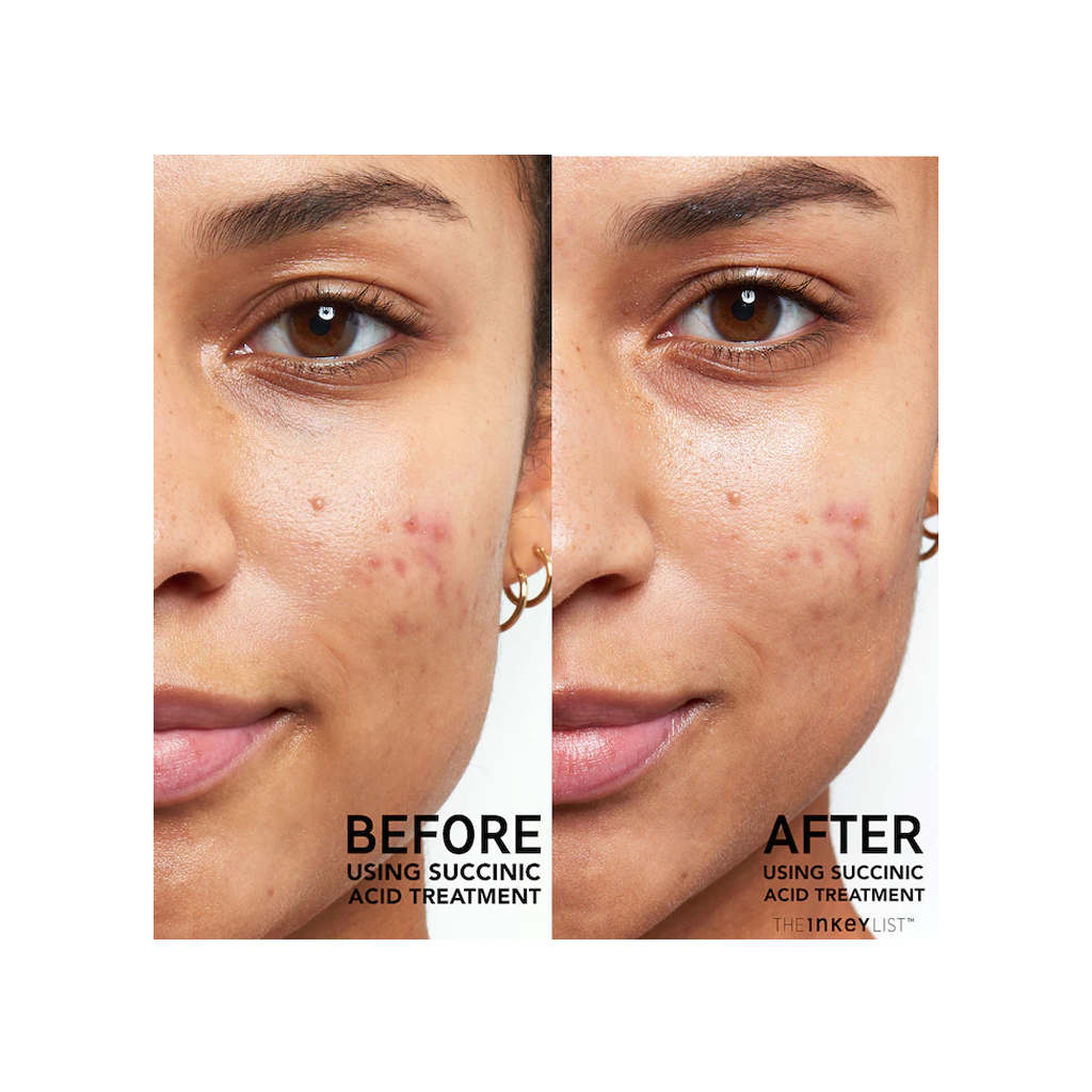 The INKEY List - Succinic Acid Acne Treatment (15ml) - MyVaniteeCase